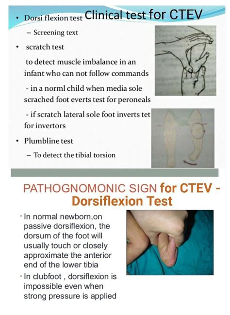 scratch test ctev|Clubfoot .